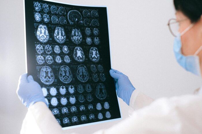 FORTALECE SECRETARÍA DE SALUD LA SENSIBILIZACIÓN SOBRE EL ALZHEIMER EN SU DÍA MUNDIAL